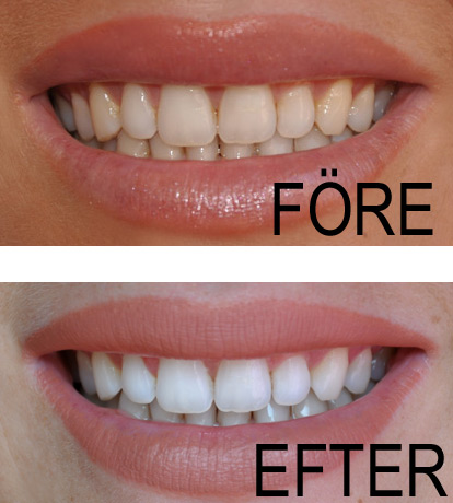 Beconfident® före efter bilder och resultat efter en tandblekning hemma.