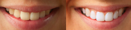 Dentaworks före efter och resultat efter tandblekning.