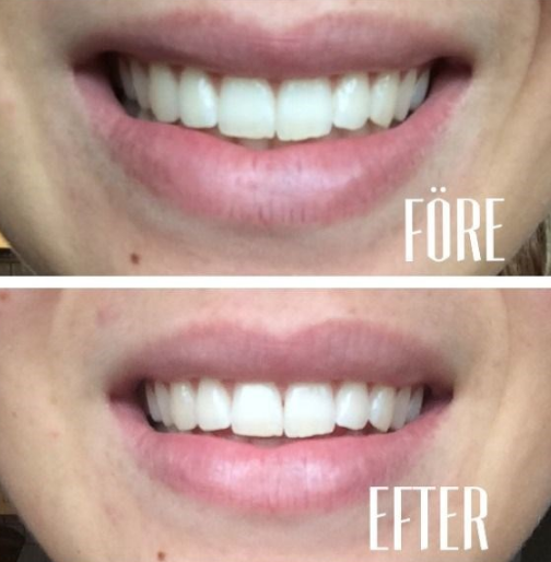 Före efter bild på tandblekning efter en huskur med bakpulver.