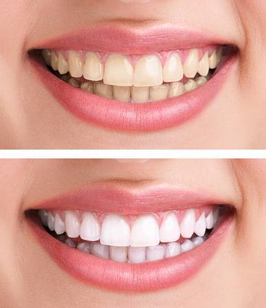 Hampaiden valkaisu ruokasoodalla ennen jälkeen kuva